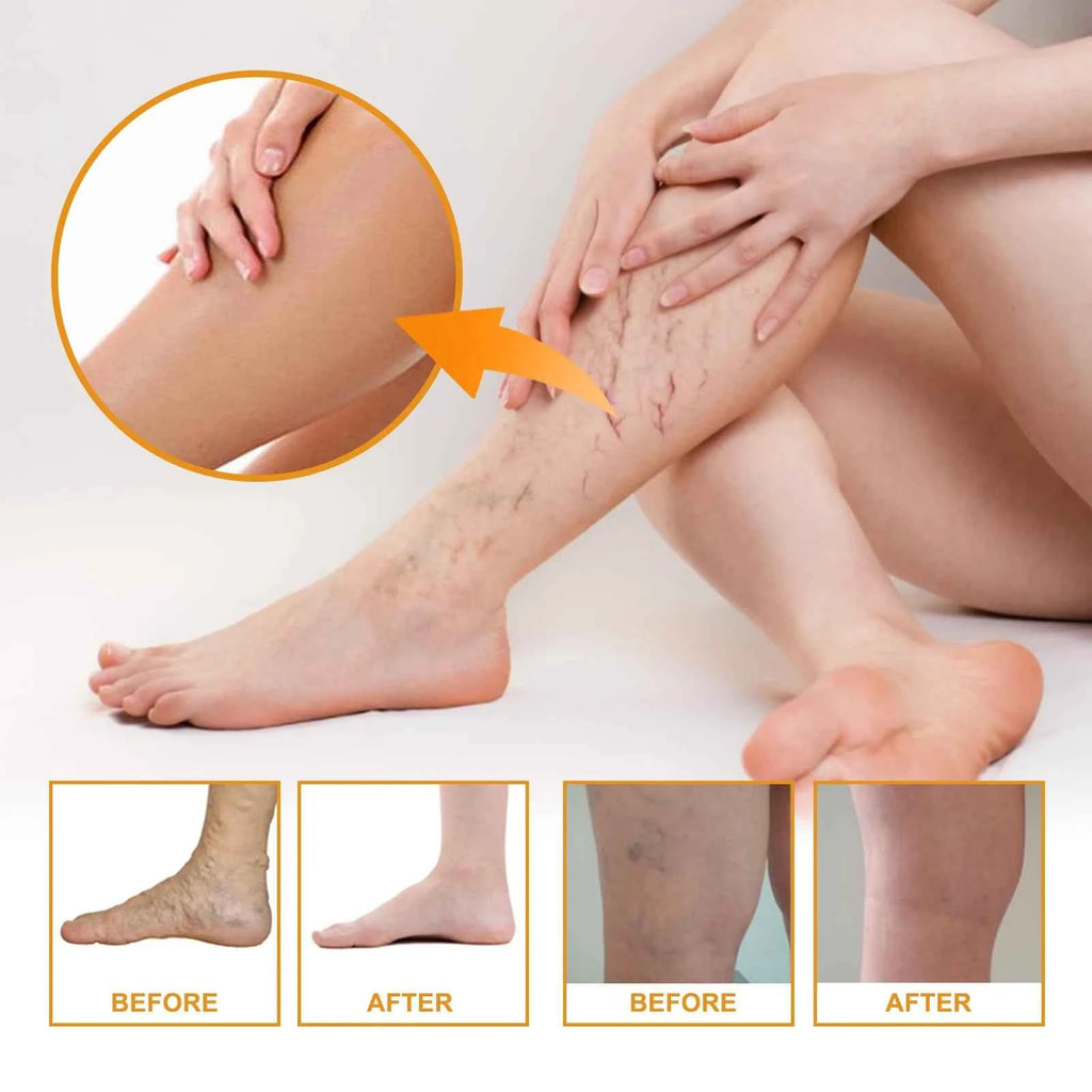 EELHOE Earthworm Leg Vein Massage Cream Vitamin K Scar Care for Sore and Swollen Legs Skin Care