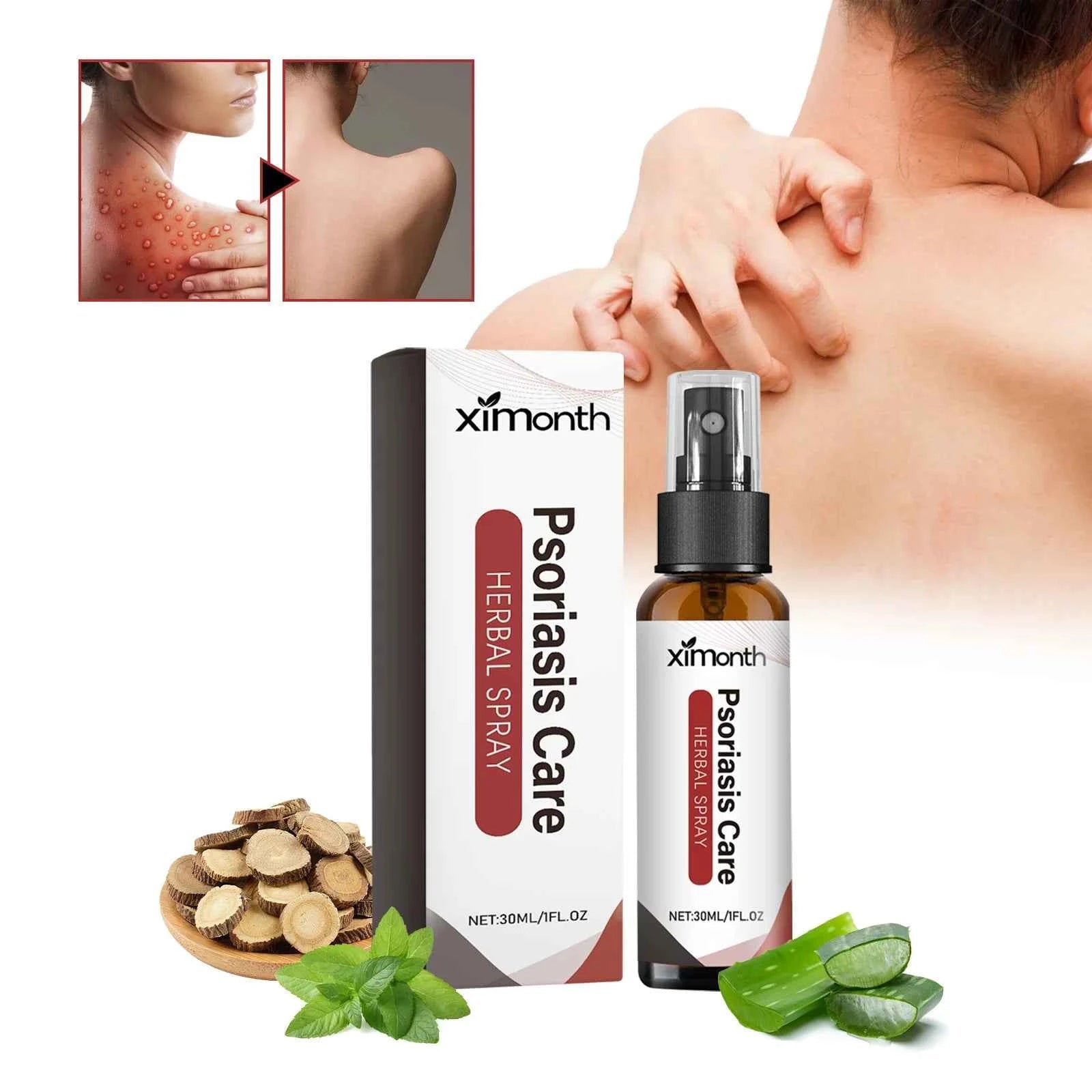 Ximonth Herbal Spray for Psoriasis Care Relieve Itchy Red Moist Skin Smooth Skin Care for Hands and Feet